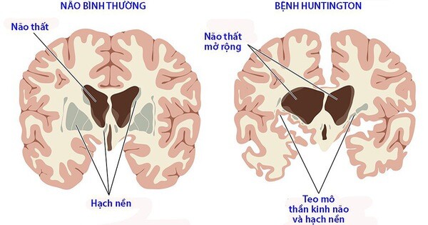 20210815 Benh Hungtinton